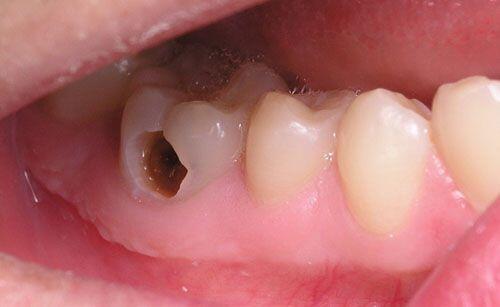 Bệnh lý răng miệng ở phụ nữ mang thai