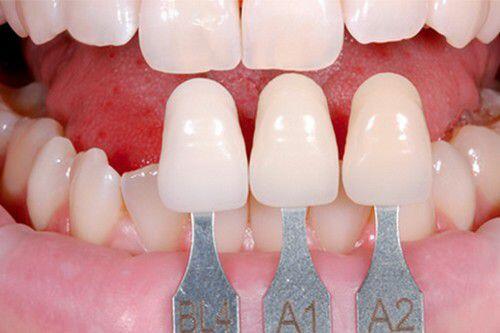 Các loại phục hình răng cố định