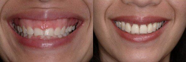 Đắp thân răng cân chỉnh lại tỉ lệ giữa răng và nướu