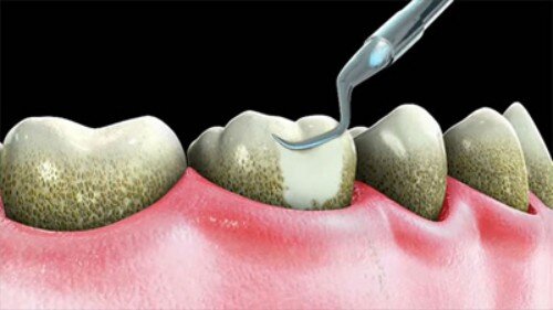 Dấu hiệu nhận biết răng sắp bị sâu