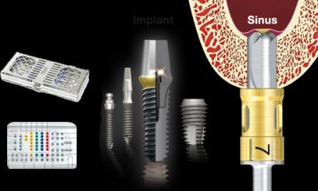 Các loại implant phổ biến nhất hiện nay