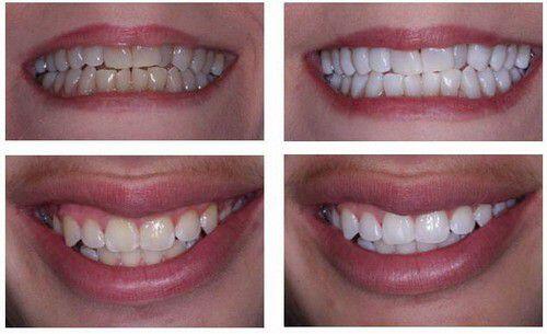 Tẩy trắng răng bằng đèn plasma có hại không ?