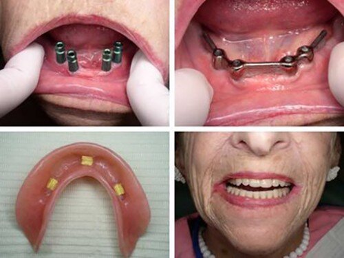 Mất hết răng thì cần phải cấy bao nhiêu implant ?