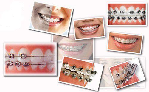 Niềng răng cũng là một phương pháp trong chỉnh hình răng hàm mặt