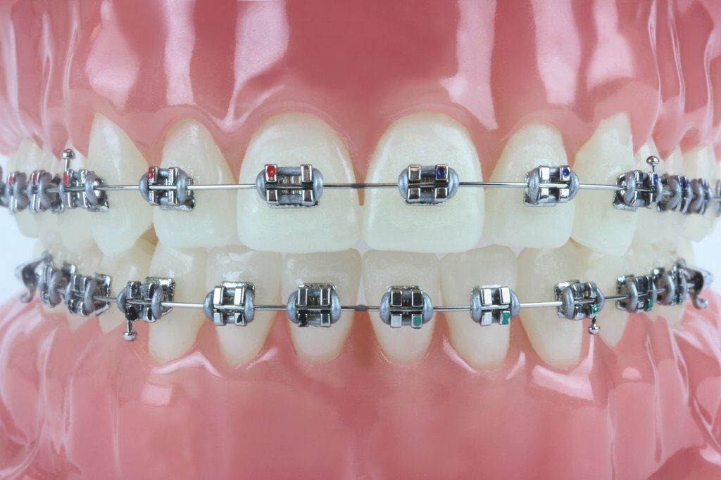 Tùy trường hợp răng thưa để áp dụng những cách khác nhau