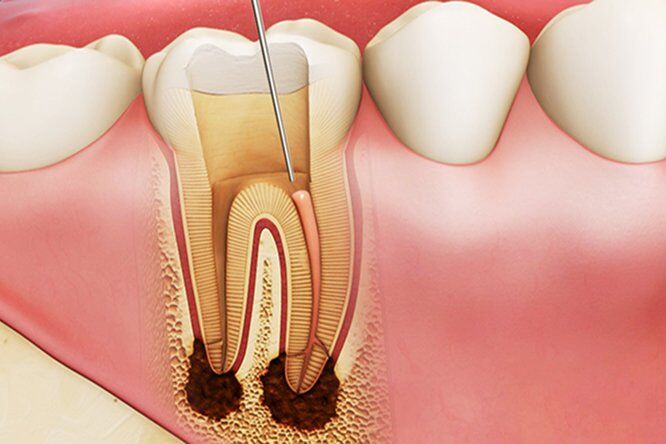 Có nhất thiết phải làm phục hình cho răng chết tủy ?