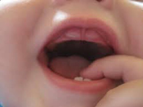 Nguyên nhân và tác hại của răng cửa mọc chậm bạn cần biết