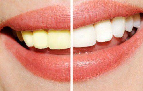 Cách tẩy trắng răng ố vàng nhanh nhất