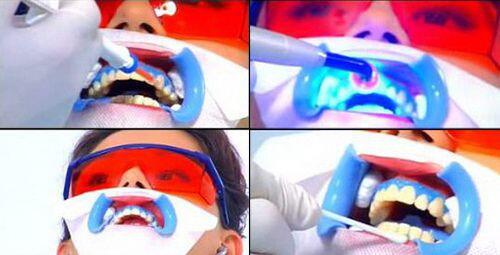 Tẩy trắng răng giá bao nhiêu tiền và hiệu quả ra sao