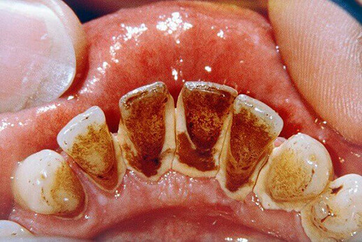 Chân răng bị đen - Nguyên nhân và cách điều trị