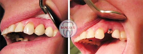 trồng răng implant có đau và nguy hiểm không