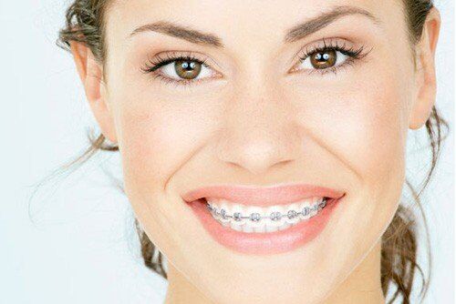 2 cách khắc phục răng hô hiệu quả nhất -1 