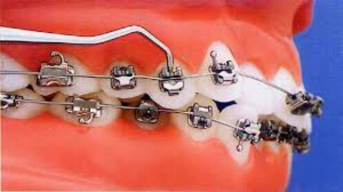 2 cách khắc phục răng hô với hiệu quả cao