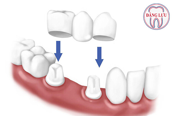 Cấy ghép implant răng hàm như thế nào?