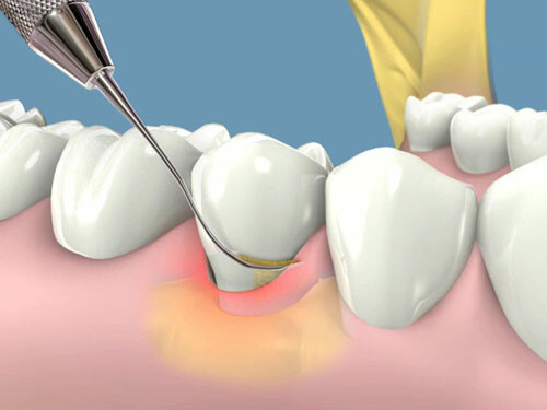 Vì sao bị ê buốt răng sau khi lấy cao răng ?