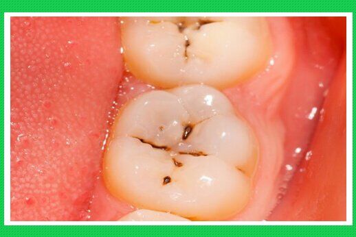 Lỗ sâu răng phát triển như thế nào ?