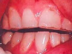 Nguyên nhân và triệu chứng bệnh nghiến răng
