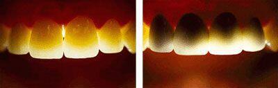 Những tổn thương của tật nghiến răng