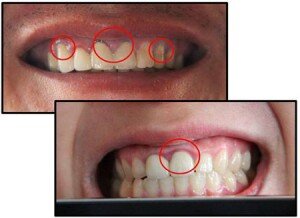 Cách bảo vệ răng sâu tốt nhất