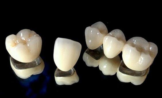 Bạn biết gì về răng sứ Titan?