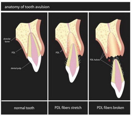 Các dạng chấn thương răng