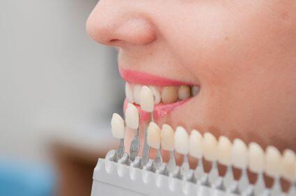 Tẩy trắng răng có nguy hiểm không ?