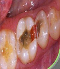 Nguyên nhân viêm quanh cuống răng và những triệu chứng cần biết