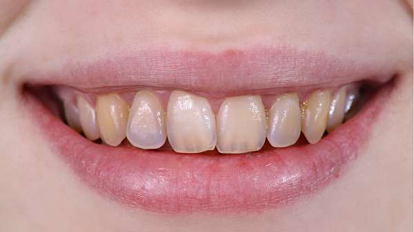 bệnh mòn răng cách phòng và điều trị