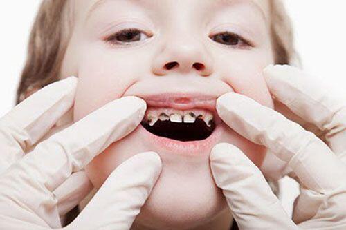 Qúa trình thay răng sữa diễn ra thế nào ?