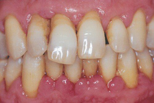 Bệnh viêm quanh răng