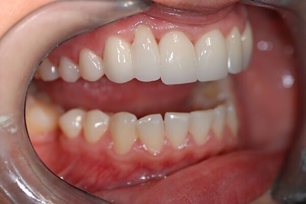bọc răng sứ nguyên hàm bao nhiêu tiền