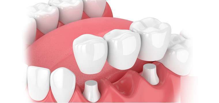 bọc răng sứ bắc cầu là gì