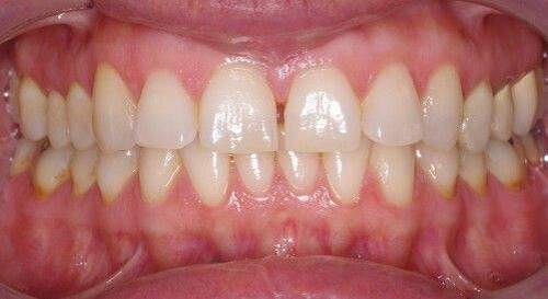 Nguyên nhân gây bệnh thiếu sản men răng 1