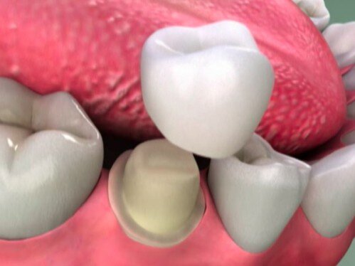 Bọc răng sứ bị đau hàm là vì đâu ?