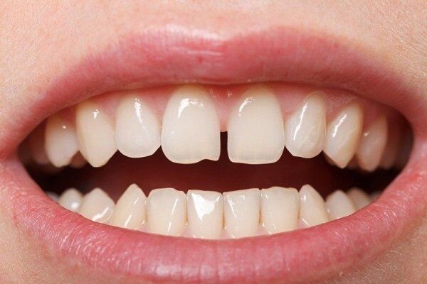 Bọc răng sứ Cercon HT cho răng thưa có hiệu quả không?