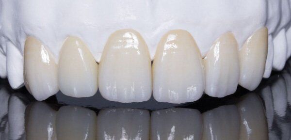 Bọc răng sứ Cercon HT có bị đau nướu không?