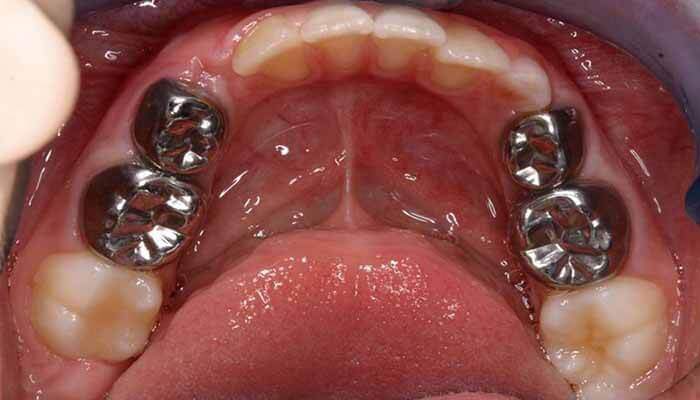 bọc răng sứ cho răng bị sâu