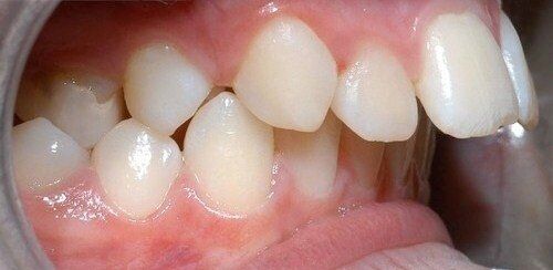 bọc răng sứ cho răng hô