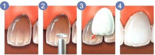 Phương pháp khắc phục thưa răng thẩm mỹ nhất hiện nay