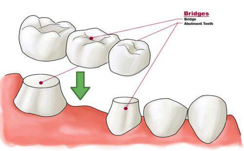 Bọc răng sứ cho trường hợp răng mòn mặt nhai
