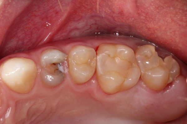 tại sao tủy răng bị viêm