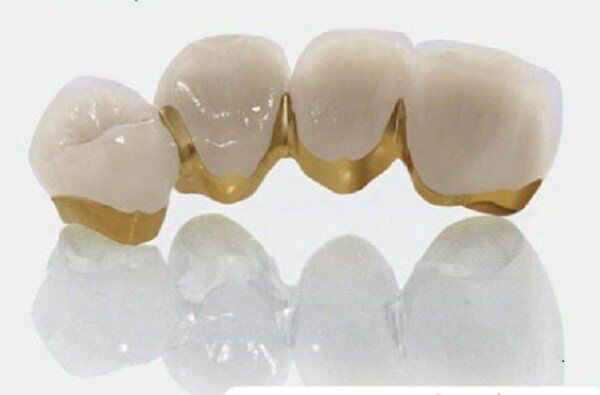 Bọc răng sứ Titan giá bao nhiêu tiền?
