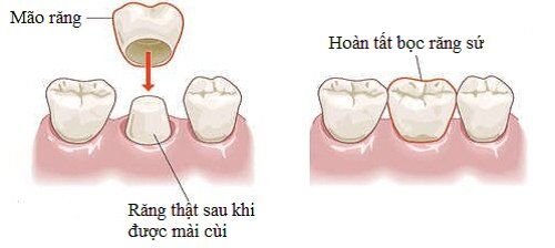 Bọc răng sứ kim loại được thực hiện ra sao?