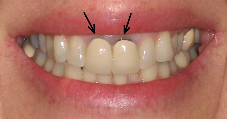 Bọc răng sứ Veneer có nhức không?