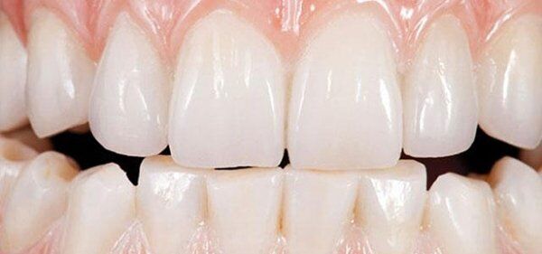 Bọc răng sứ Zirconia a cao cấp ở Tp. HCM