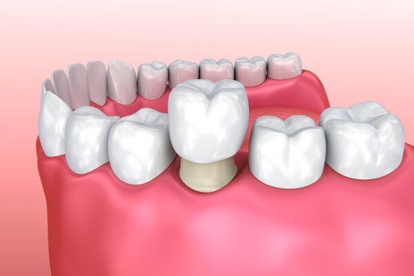 bọc răng sứ cho răng chết tủy