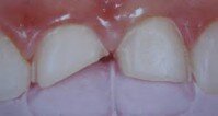 Các dạng chấn thương răng