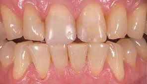 Các dấu hiệu cho thấy răng bạn đang bị lão hóa