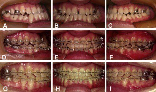 Các giai đoạn niềng răng