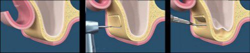 Có mấy kiểu phẫu thuật nâng xoang khi trồng răng implant ?